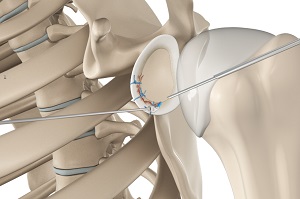 Bony Instability Reconstruction of the Shoulder