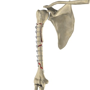 Complex Fracture Repair of the Shoulder
