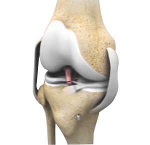 Failed Anterior Cruciate Ligament (ACL) Reconstruction