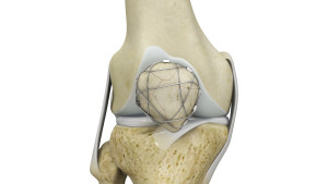 ORIF of the Knee Fracture